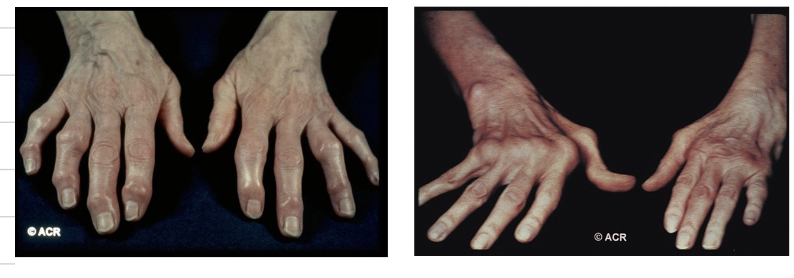 <p>From the following image, explain which photo resembles OA and RA</p>
