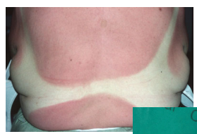 <p>Epidermal</p><p><em>Epidermis</em></p>