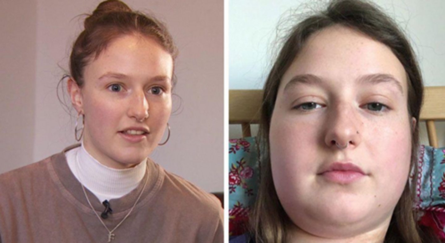 <p>viral sialadenitis</p>