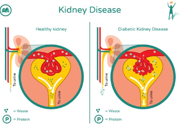 <p>A slow decline in glomerular filtration rate due to diabetes and linked to retinopathy (damage to the retinas)</p>