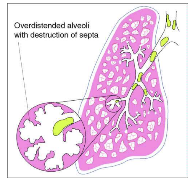 <p>slowly progressive disorder (often due to smoking) in which the distal air spaces enlarge, and lungs become hyperinflated; often also develops chronic bronchitis </p><ul><li><p>trachea = midline </p></li><li><p>tactile fremitus = decreased </p></li><li><p>percussion = hyper-resonant </p></li><li><p>breath sounds = decreased to absent </p></li><li><p>adventitious sounds = none or scattered coarse crackles and/or sonorous wheezes (rhonchi) associated with chronic bronchitis </p></li><li><p>Over time will develop barrel chest, severe DOE, and decreased diaphragmatic excursion </p></li><li><p>COPD </p></li><li><p>exhalation is the problem, still left over air that’s trapped, so over time it increases! </p></li></ul><p></p>