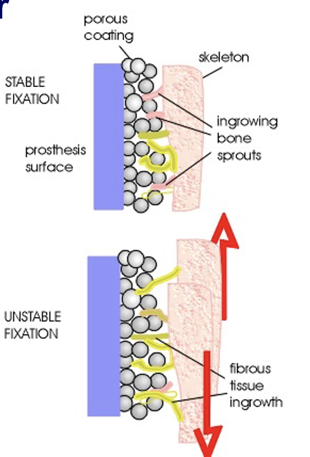 <p>cement<strong>less</strong> hip prosthesis: disadvantages </p>