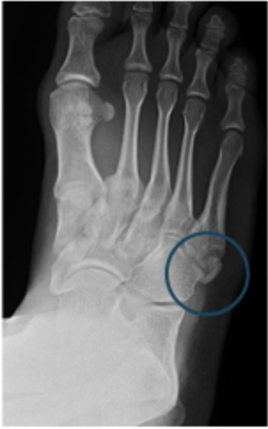 <p>Game plan for Zone I 5th metatarsal base fracture</p>