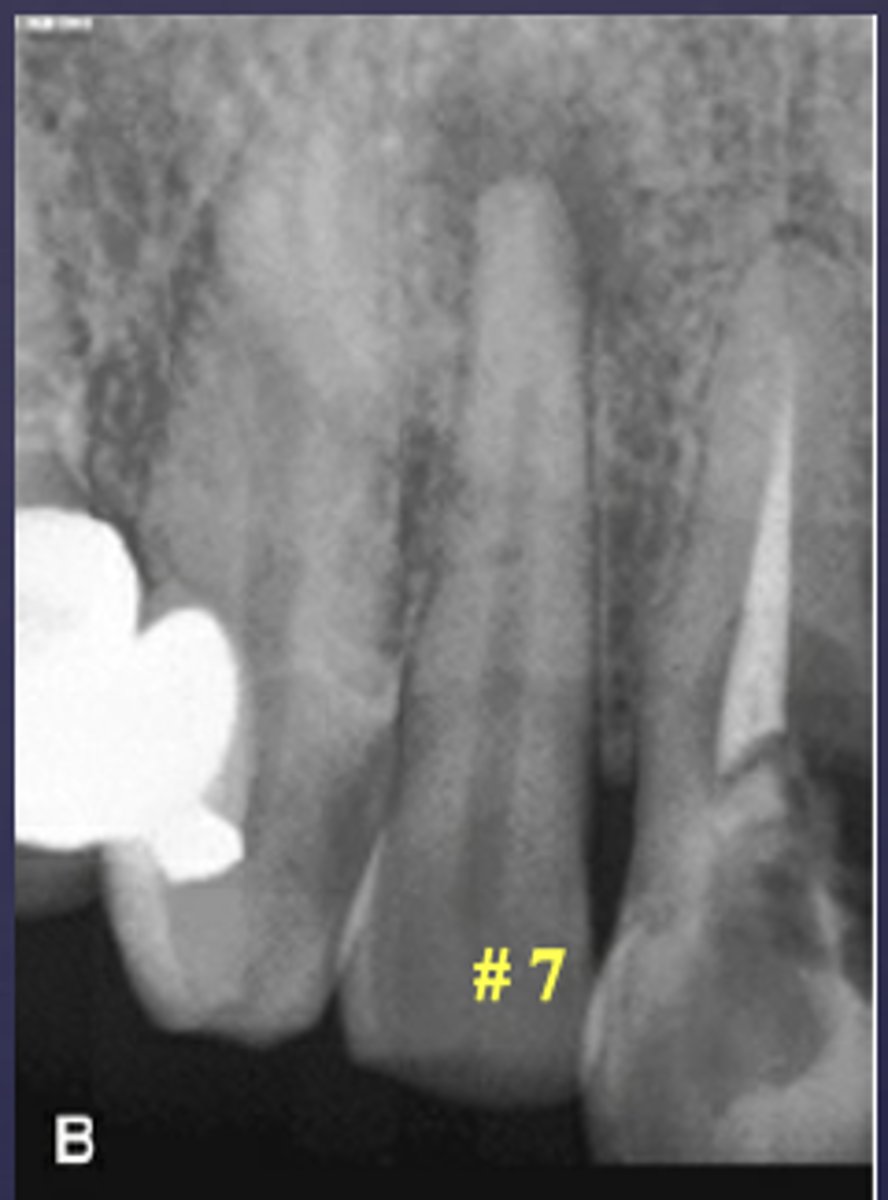 <p>What condition is present in this radiograph?</p>