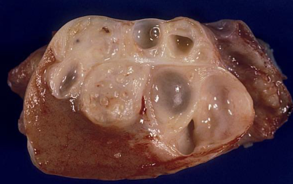 <p>Teratoma</p>