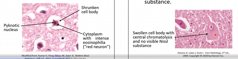 <p>Reactions of Neurons to Injury</p><ul><li><p>Acute Hypoxia/Ischemia: the cell body will shrink (nuclear pyknosis), causing a “red neuron”</p></li><li><p>Axonal Injury: the cell body will swell and the nuclei enlarges, thus the cytoplasm becomes “pale” (central chromatolysis)</p></li><li><p>Intracellular Inclusions: aggregated proteins</p></li></ul><p></p>