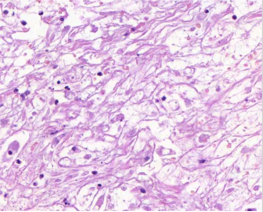 <p>mitä nähdään tuumorin alueella? (vinkki: liposarkooma)</p>