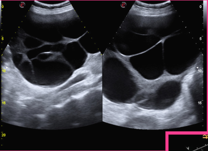 <p>What is the largest functional cyst?</p>