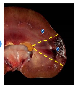<p>Denaturing of cytoplasmic proteins causing cellular detail to be lost but architectural detail is maintained (we can recognize the type of tissue) </p><p>Common in kidneys, liver, heart, skeletal muscle </p>