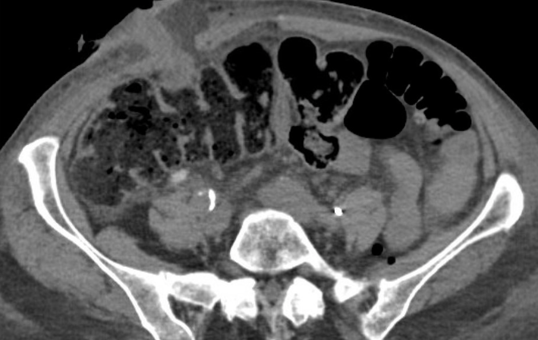 <p><span>Five days after radical cystectomy and ileal conduit, a 72-year-old woman has mild pain around the stoma. CT is shown</span></p>