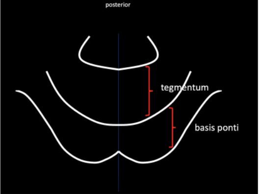 <ul><li><p>Basis ponti (anteriorly)</p></li><li><p>Tegmentum (posteriorly)</p></li></ul><p></p>