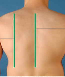 <p>posterior version of the mid- clavicular line</p>