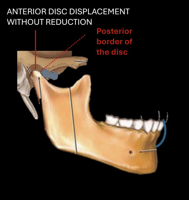 <p>articular eminence hits the posterior border of disc instead of normal resting position</p>