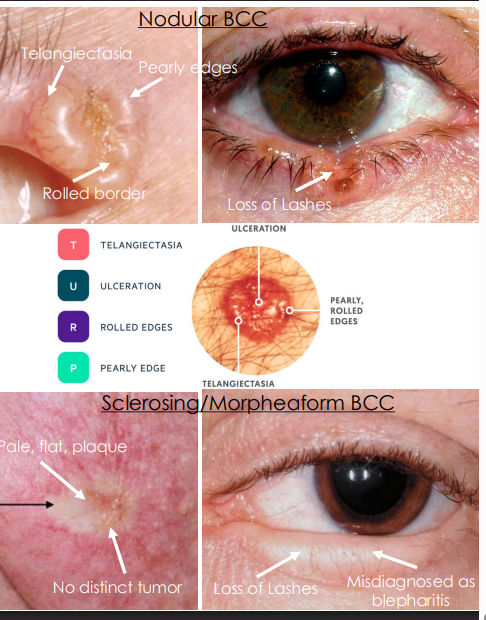 <ol><li><p><strong><u>. Nodular and Noduloulcerative (Rodent Ulcer) 80% of Eyelid BCC</u></strong></p><ol><li><p>•<strong><u> Pearly, waxy</u></strong>, translucent tumor with <strong><u>rolled borders with telangiectasia (feeder vessels)</u></strong></p></li><li><p>• <strong><u>Loss of hair</u></strong> or lashes<strong><u>, become bleeding ulcer</u></strong></p></li></ol></li><li><p><strong><u>2. Sclerosing/ Morpheaform &lt;2% of Eyelid BCC</u></strong></p><ol><li><p><strong><u>• Pale, flat, ill-defined margins</u></strong>, hardened plaque</p></li><li><p>• No distinct tumor, difficult to diagnose, invasive</p></li></ol></li></ol><p></p>
