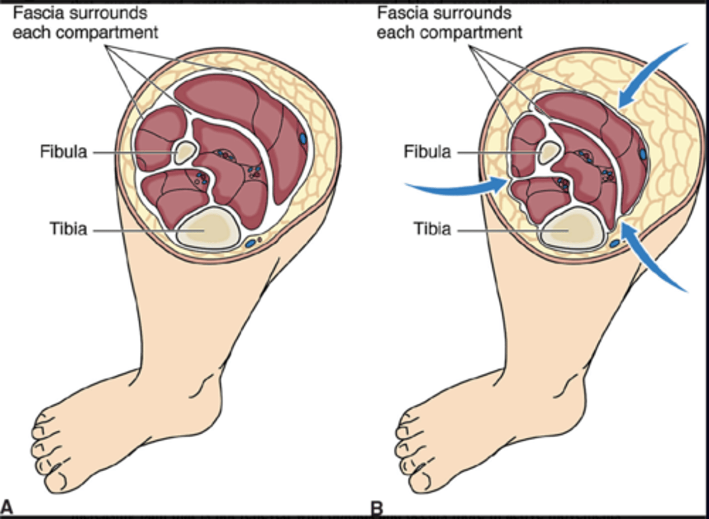 <p>Acute compartment syndrome is a limb-threatening condition in which pressure in limb compartments increases. This causes reduced circulation to the compartment's muscles and nerves.</p>