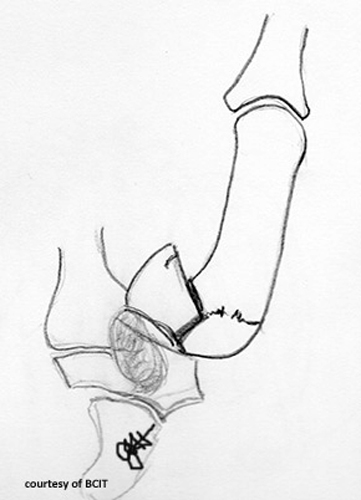 <p>Fixation with pins or K-wires; loss of thumb function (opposition/grip) is a serious concern.</p>