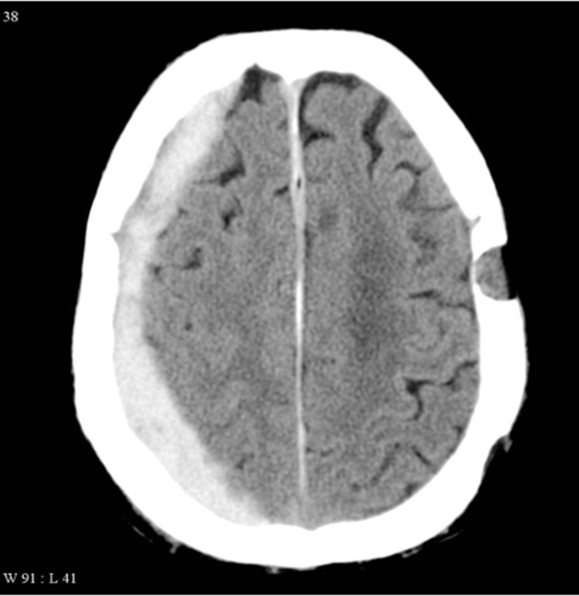<p>Crescent-shaped intracranial bleeding after head injury in the elderly; can be acute on chronic</p>