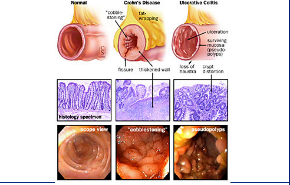 <ul><li><p>the disease can skip passages in the colon and cause inflammation → patchy inflammation</p></li><li><p><strong>Fistulas:</strong> abnormal passageways that form between different parts of the body</p><ul><li><p>→ transmural ( tears through the tissue of them muscle) inflammation → feces can end up in urine</p></li></ul></li><li><p><strong>granulomas</strong>: clusters of cells that form when the body&apos;s immune system attempts to contain and eliminate foreign substances or bacteria</p></li><li><p>muscle hypertrophy</p></li><li><p>cobblestone appearance</p></li><li><p>fat wrapping</p></li><li><p>serological marker: ASCA</p></li></ul>