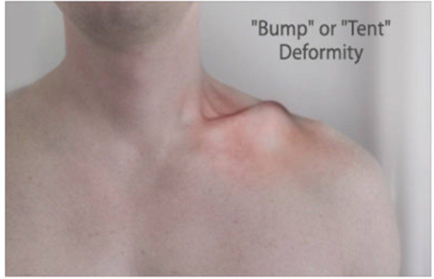 <p>bump or tent deformity</p><p>shoulder droop</p>