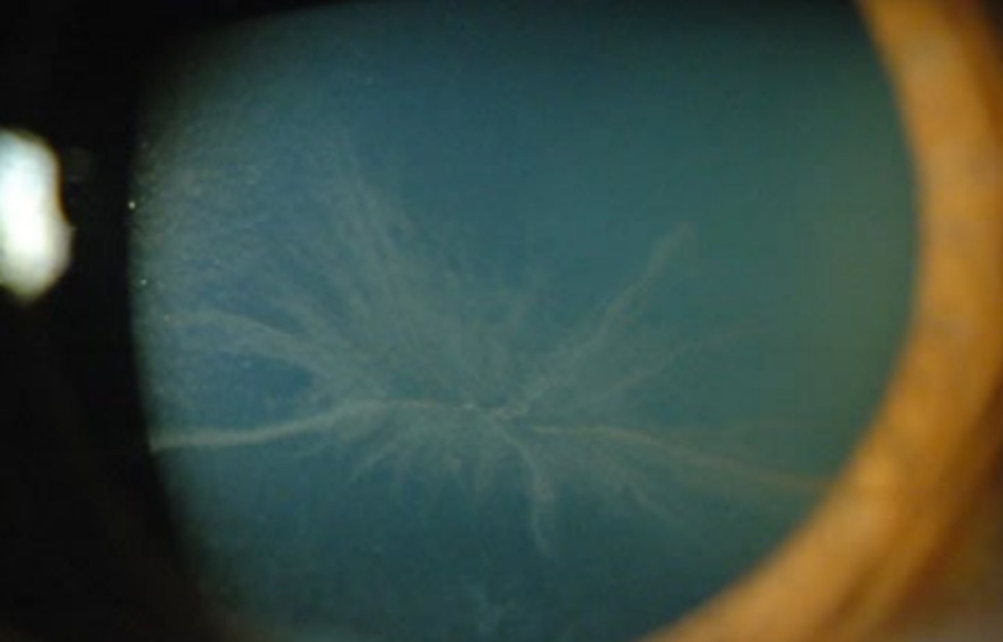 <p>condition involving a whirl like pattern of powdery white epithelial deposits that form a vortex pattern in the inferocentral cornea that spares the limbus.</p>