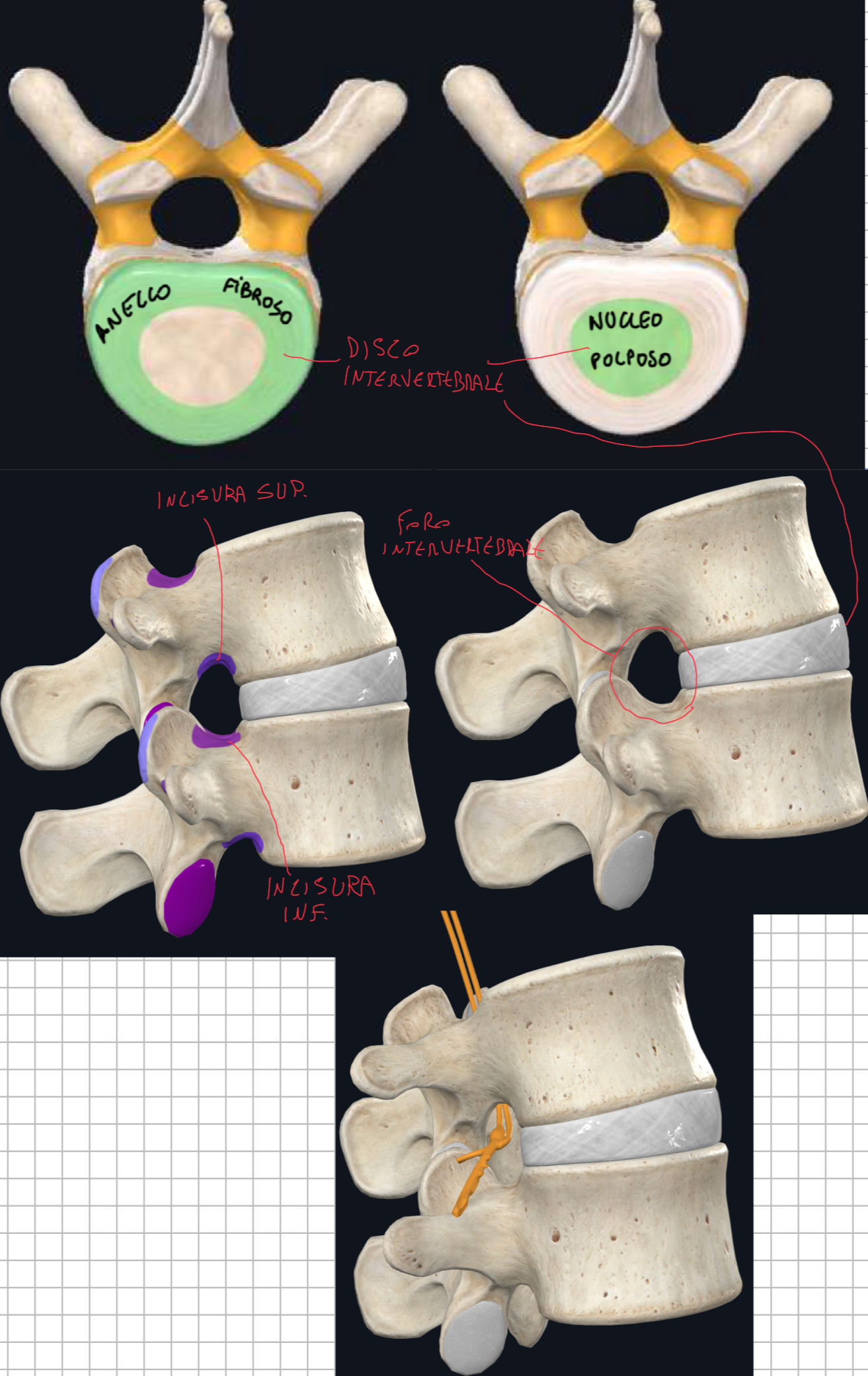 <p>Foro Intervertebrale:</p><ul><li><p>E’ l’apertura che si crea tra due vertebre adiacenti.</p></li><li><p>Da esso escono i Nervi Spinali (che derivano dall’unione di radici anteriori e posteriori) che divideranno in rami anteriori e posteriori</p></li></ul><p>Limiti:</p><ul><li><p>Anteriormente → faccia posteriore corpo vertebrale</p></li><li><p>Superiormente → incisura vertebrale inferiore della vertebra sovrastante (più ampia)</p></li><li><p>Inferiormente → incisura vertebrale superiore della vertebra sottostante (più piccola)</p></li><li><p>Infero-anteriormente → disco intervertebrale</p></li><li><p>Posteriormente → processi articolari</p></li></ul><p>Clinica - Ernia al Disco:</p><ul><li><p>Un’ernia al disco non è lo spostamento dell’interno disco intervertrebale tra due vertebre adiacenti, ma solo della sua componente centrale, il Nucleo Polposo.</p></li><li><p>Quindi indica la fuoriuscita del Nucleo Polposo, attraverso un punto di debolezza dell’anello fibroso (creatosi per invecchiamento e movimenti ripetitivi), verso il foro intervertebrale&nbsp;</p></li><li><p>Il nervo spinale occupa la parte superiore del foro, proprio subito al di sopra del disco intervertebrale → per cui questa erniazione andrà a comprimere il nervo causando dolore, parestesie e deficit motorio-sensitivi.</p></li></ul><p></p>