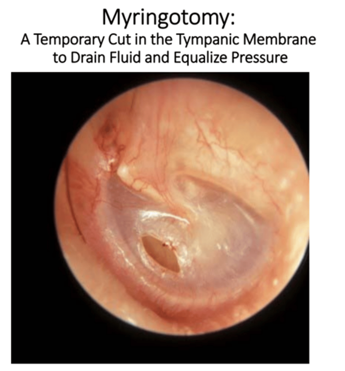 <p>• Muncie Technique, Galbreath Technique</p><p>• Acupuncture/ Dry Needling</p><p>• Dietary and Supplementation (numerous options)</p><p>• Antibiotics</p><p>• Myringotomy with or without Tympanostomy Tubes</p><p>• Nasal saline drops and nasal syringe</p>
