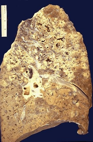 <p>Característica de tuberculosis hasta demostrar lo contrario.</p><p><span><span>Tipo de muerte celular donde el tejido se desintegra en una masa blanquecina, granular y quebradiza, similar al queso o requesón, perdiendo su estructura original y quedando envuelta en un granuloma inflamatorio</span></span></p>