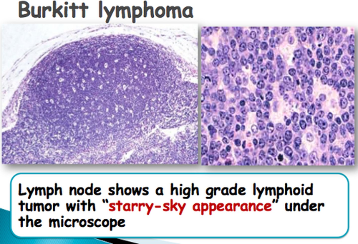 <p>8:14 translocation; associated with EBV; "starry sky" appearance on histology</p>