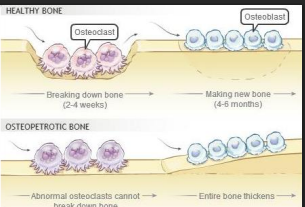 <p>decreased osteoclastic activity </p>