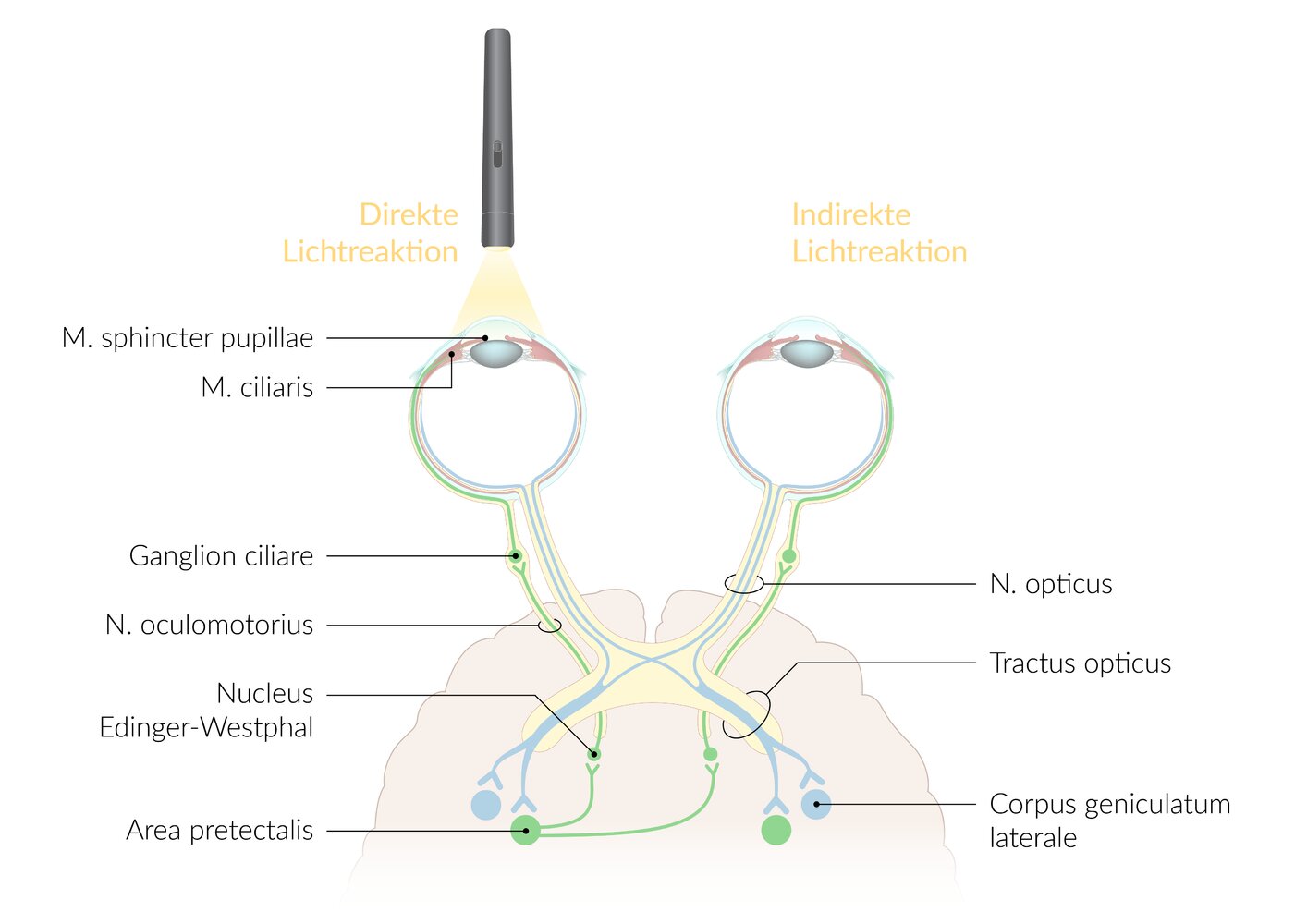 <p>D. Lesion of the left optic nerve (N. opticus) and the left oculomotor nerve (N. oculomotorius)</p>