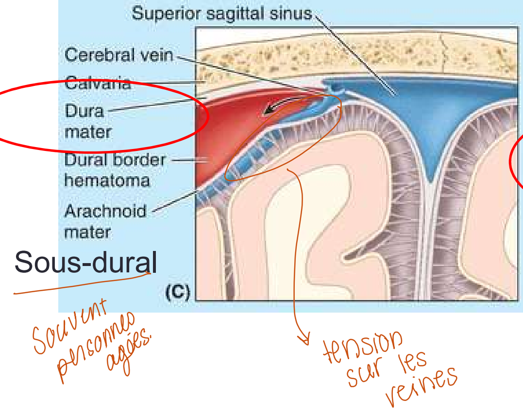 <p>Accumulation de sang entre la dure mère et l’arachnoïde. Le sang provient du sinus veineux </p>