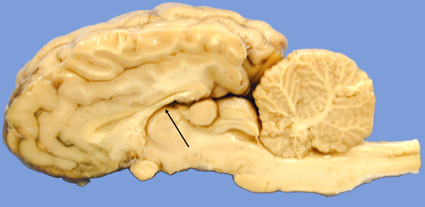 <p>third ventricle</p>