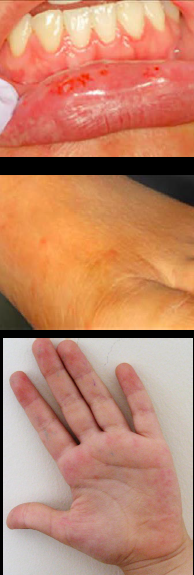 <p><span style="color: blue;"><strong><em><u>SPECIFIC INFECTIONS</u></em></strong></span></p><p>Hand-Foot-Mouth Disease</p><ul><li><p>Clinical Signs</p></li><li><p>Etiology</p></li><li><p>Treatment</p></li></ul><p></p>