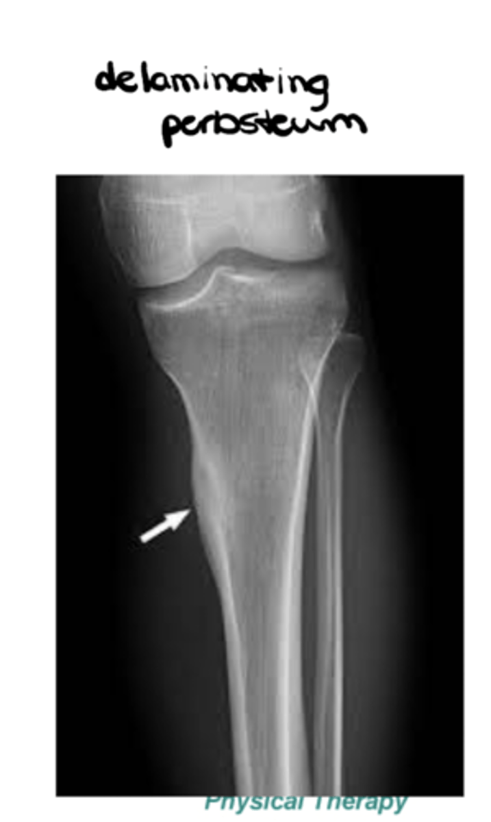 <p>- Solid</p><p>- Laminated</p><p>- Sunburst</p><p>- Codman's triangle</p>