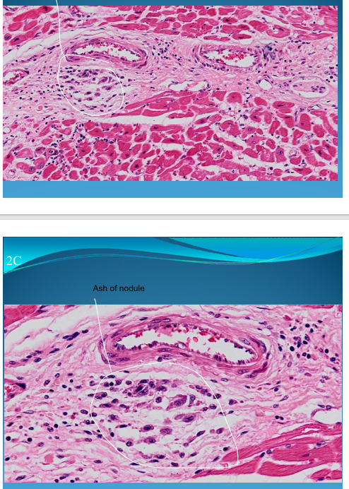 <p>HEART:</p><p>Rheumatic Myocarditis: Aschoff Nodules under vessel perivascular and Aschoff cells</p>
