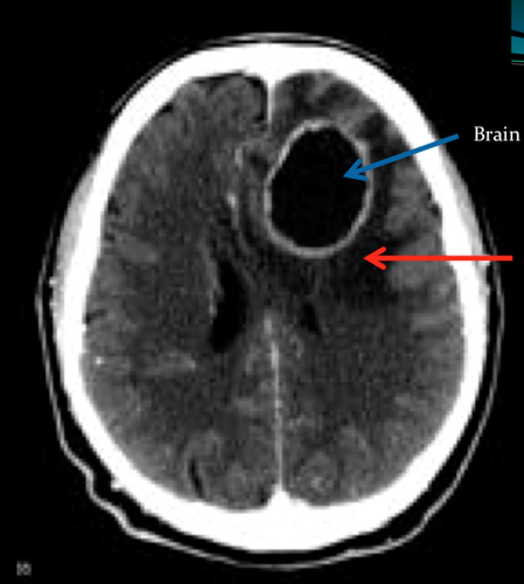 <p>Define Condition:</p><p>Discrete destructive lesion with liquefactive necrosis, surrounding edema and rim of granulation tissue, with fibrosis and gliosis</p><p>-May be implanted, local extension from sinusitis or mastoiditis, hematogenous (STAPH IV spread)</p><p>-Dx: IICP, Herniation, LP = HIGH PROTEIN, PMNs, normal glucose (abscess is walled off)</p><p>-Tx: surgical drainage plus antibiotics may reduce mortality to 10%.</p>