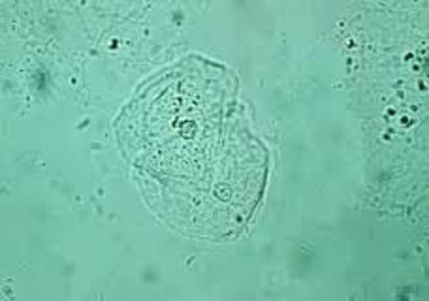 <p>increased numbers usually seen in urine from females. May obscure RBCs &amp; WBCs. Reduced by collecting midstream clean-catch specimen.</p><p>description: 40-50 μm. Flat. Prominent round nucleus.</p><p>origin: lower urethra, vagina</p>