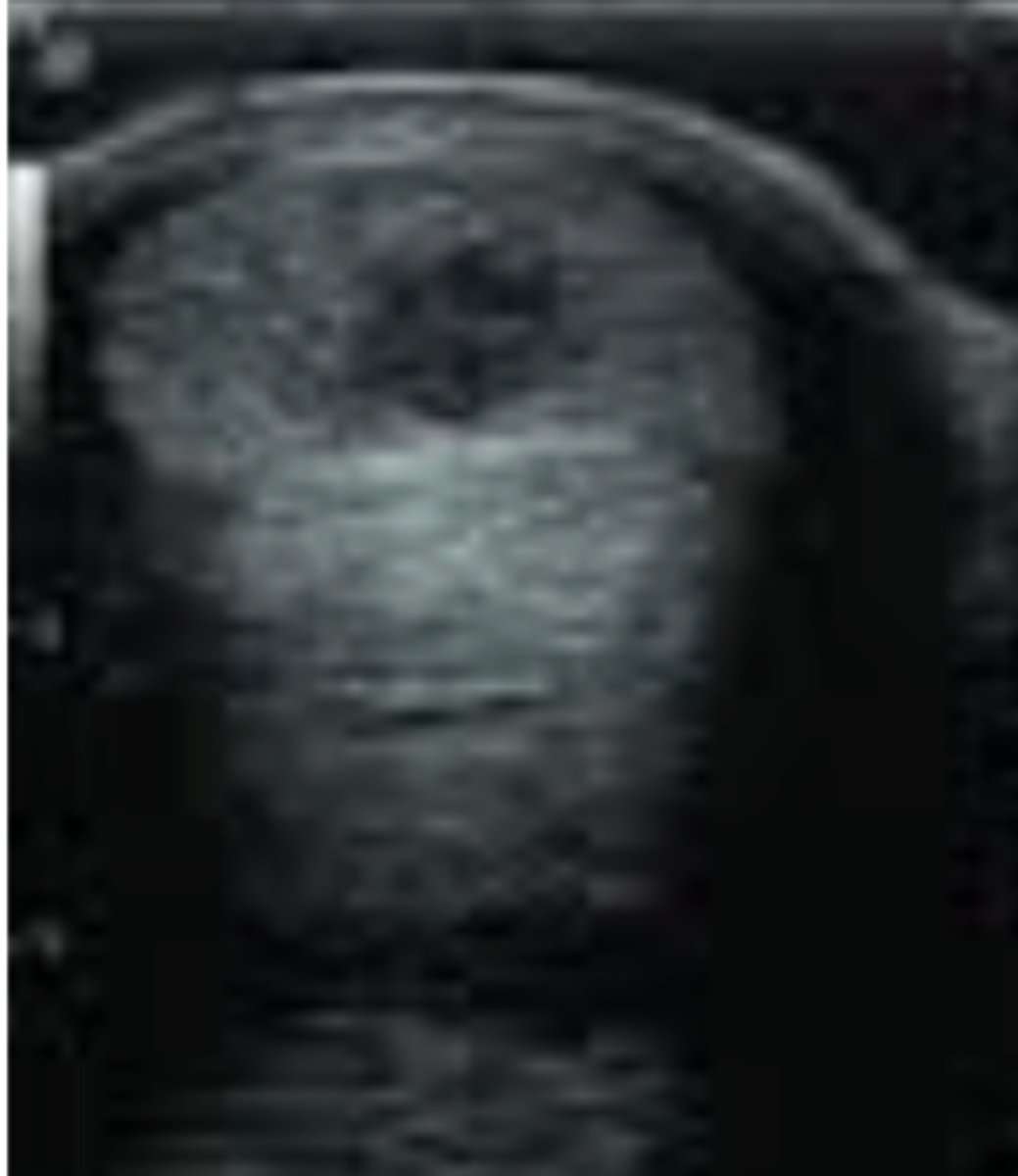 <p>7 year old thoroughbred presents with acute lameness, swelling of metacarpal?; ultrasound shows this- what is this?</p>