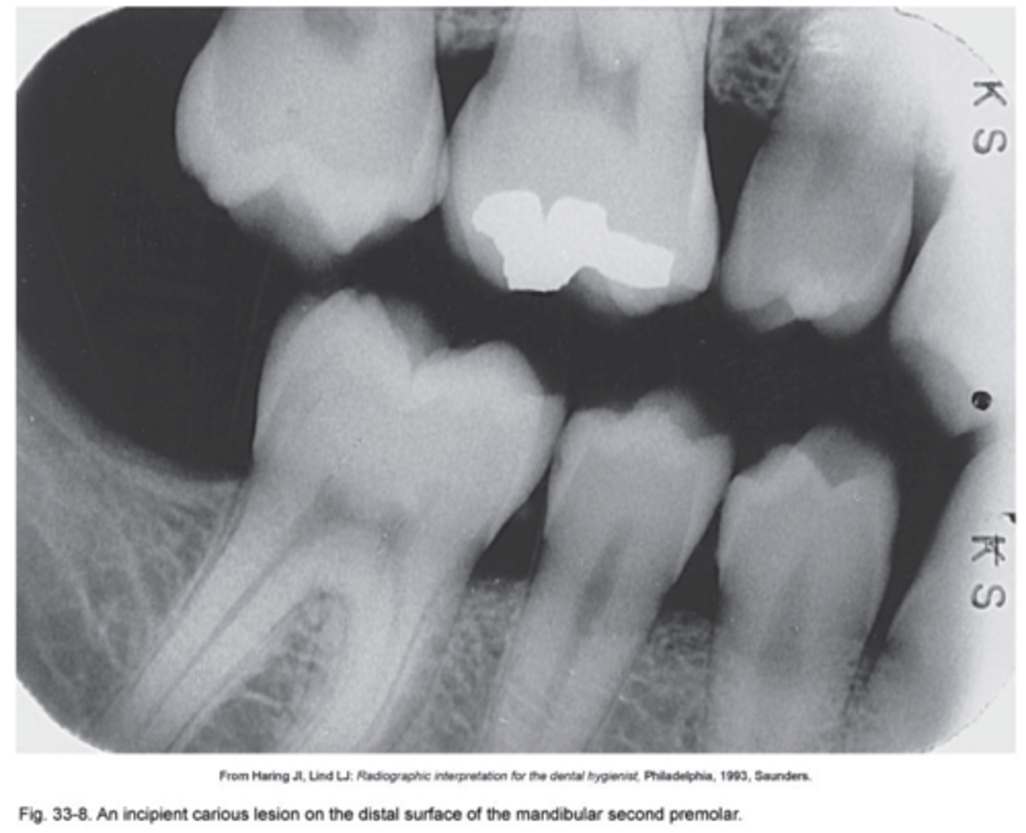 <p>Extends<strong> less than halfway</strong> through the thickness of enamel. Class I</p>