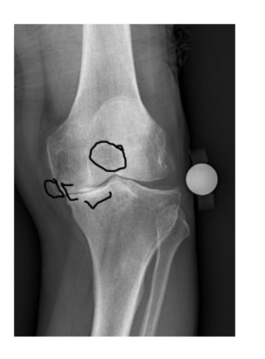 <p>A non-inflammatory degenerative disorder of moveable joints characterised by the deterioration of articular cartilage and the formation of new bone</p>
