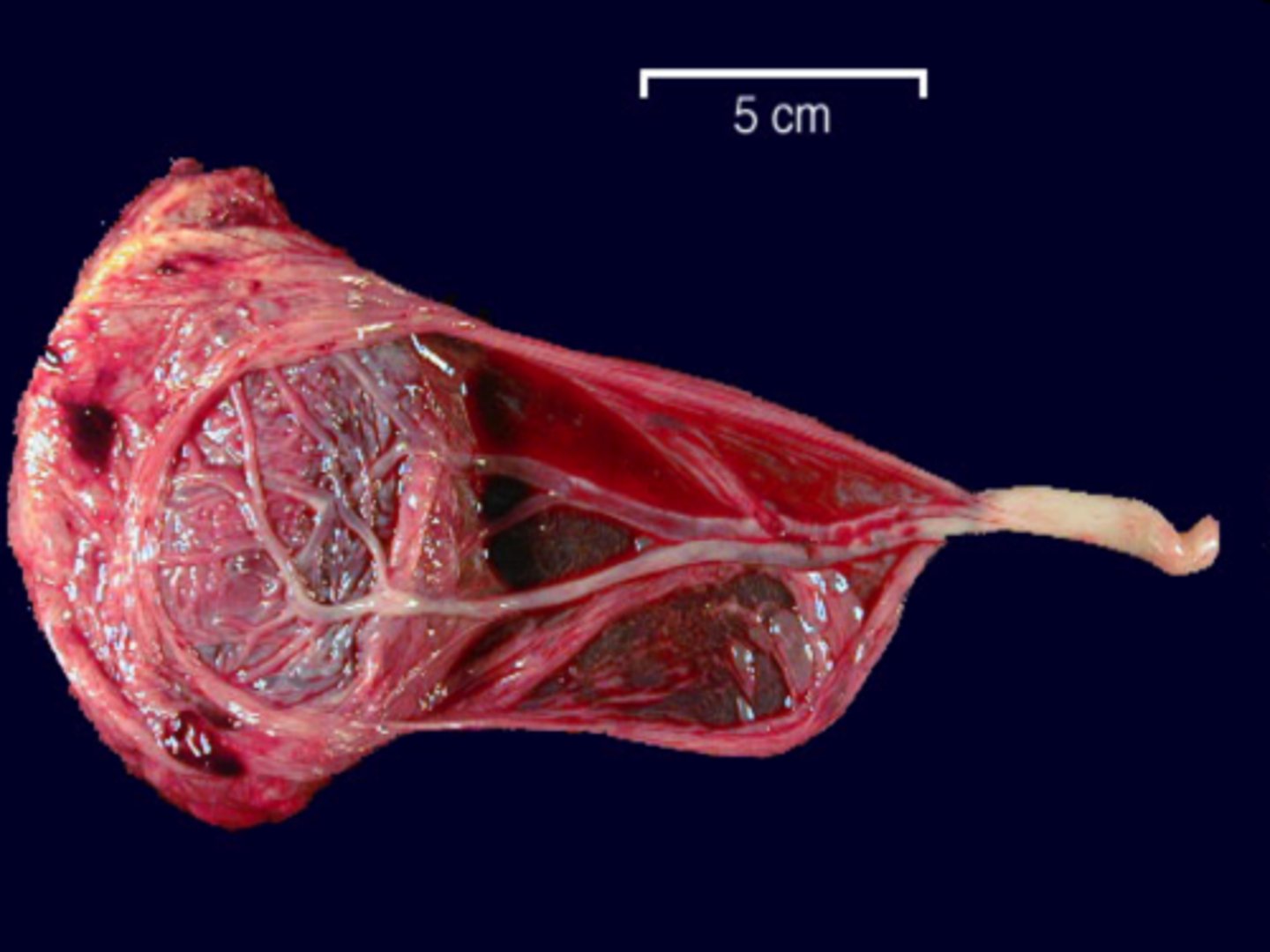 <p>Rare</p><p>Associated with previa and multiple gestation</p><p>-Cord vessels branch at membranes and then into placenta</p><p>Rupture of membranes or traction</p><p>-Can tear the vessels->Fetus bleeds to death</p>