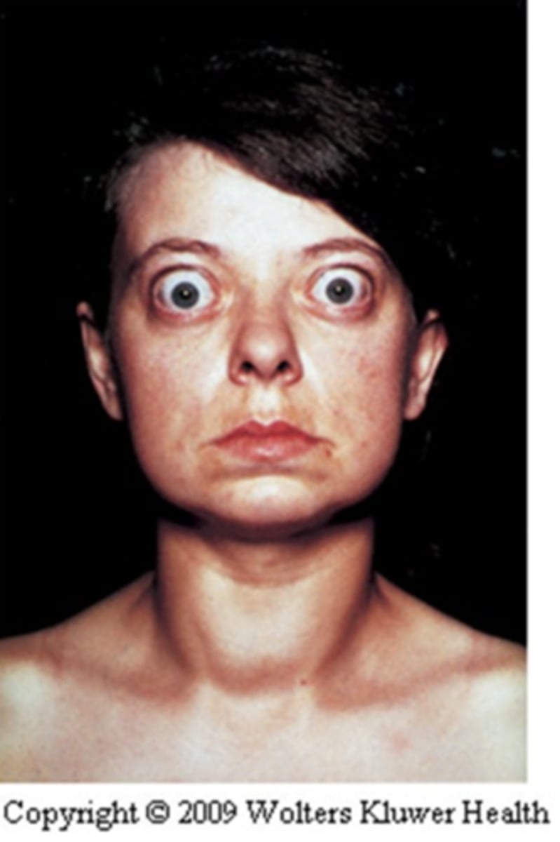 <p>The patient’s thyroid is diffusely hyperplastic. The follicles are lined by tall columnar epithelial cells that project into the lumina. These cells actively resorb the colloid in the centers of the follicles, resulting in the "scalloped" appearance of the edges of the colloid.</p><p>Lab test indicates positive Thyroid Stimulating Immunoglobulins (TSIs).</p><p>What is most likely the patient’s diagnosis?</p>