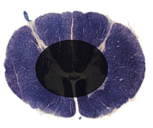 <p>a lesion here would cause…?</p>
