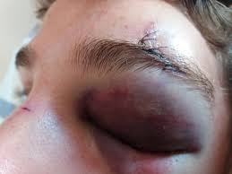 <p><strong>Acumulación de sangre</strong> fuera de los vasos sanguíneos, formando una colección o <strong>bulto palpable o cavidad neopalpable</strong>. Aparece después de un golpe fuerte, cirugía. EL tamaño varia de acuerdo a la violencia ejercida en su producción.&nbsp;</p><p>Ojos de mapache=fractura de la base del cráneo</p>