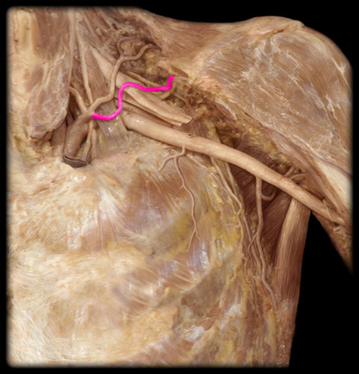 <p>branch off subclavian a. --> runs above the superior transverse scapular ligament over the suprascapular notch - supplies blood to supraspinatus and infraspinatus mm. (army goes over the bridge...)</p>