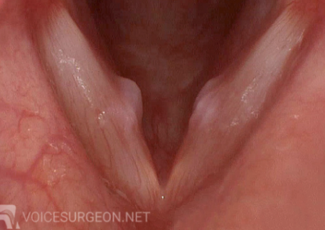 <p><strong>bi</strong>lateral lesions on true vocal cords </p>