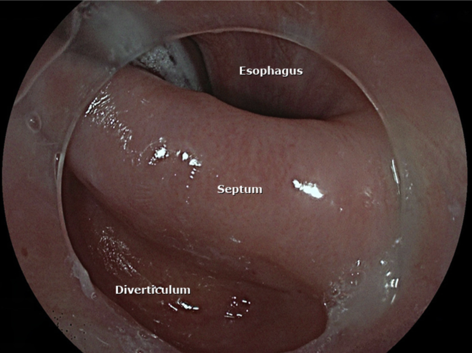 <p>What causes a Zenker Diverticulum?</p>