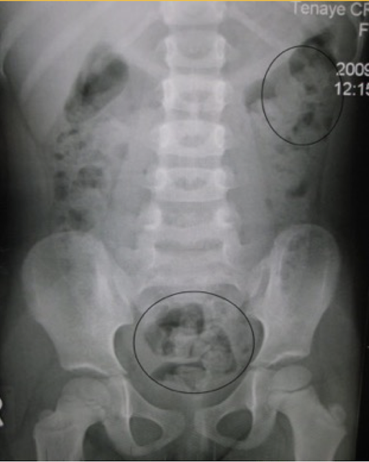 <p>mottled appearance of fecal material </p><p><em>Abdominal Radiograph</em></p>