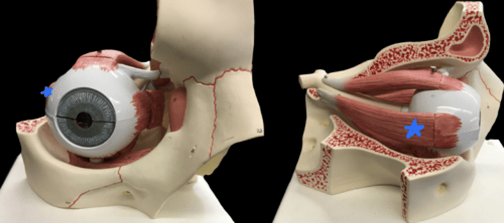 <p>lateral side eye muscle</p>