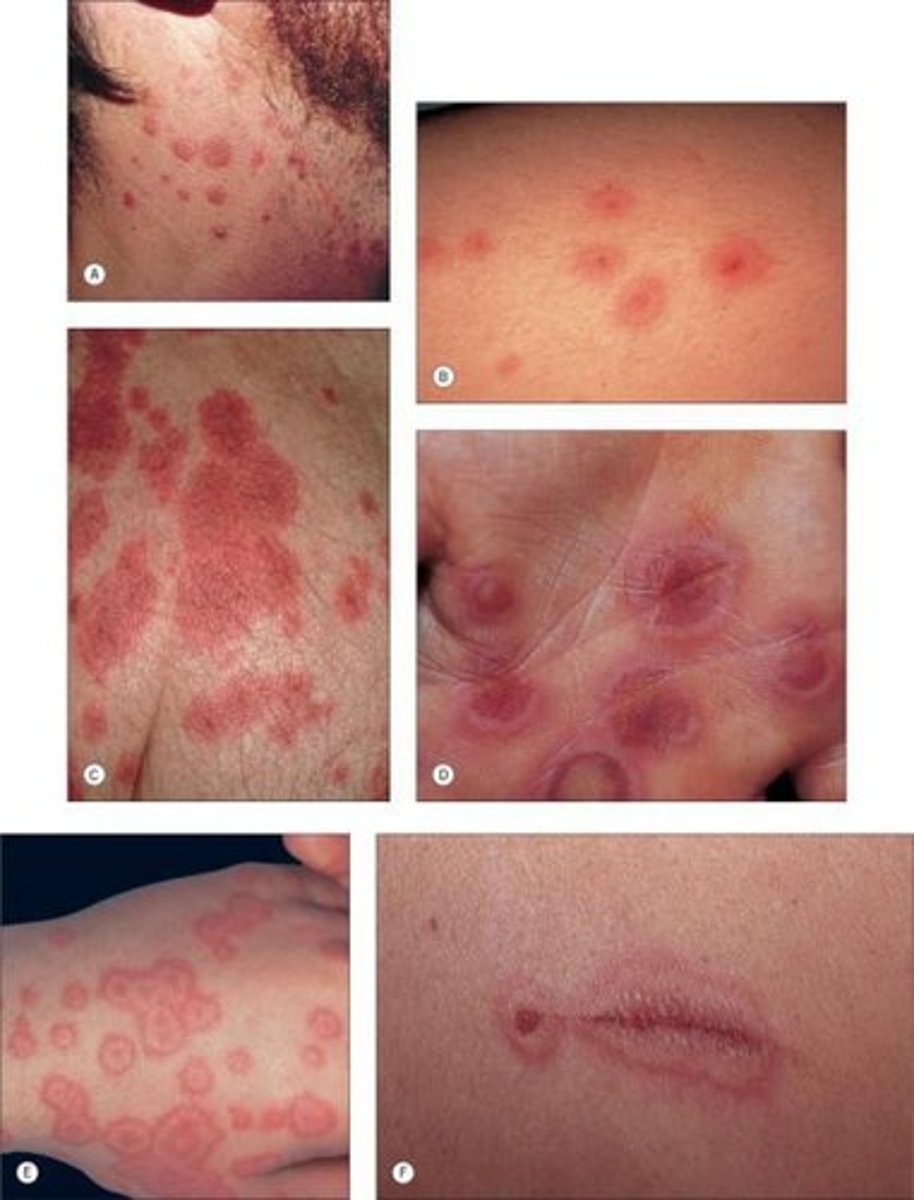 <p>erythema multiforme minor; major</p>